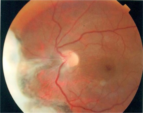 Figure 2 Postoperative view, showing a nasal exit.