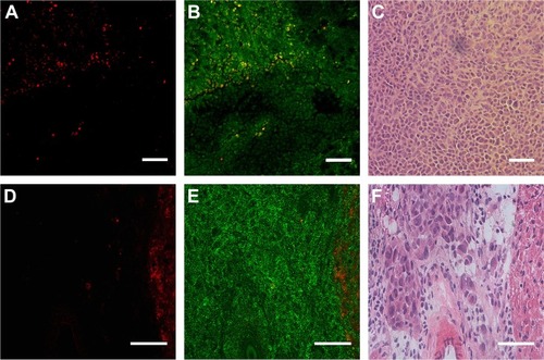 Figure 7 Micrographs showing QD-loaded MSCs in (A–C) tumor and (D–F) metastatic tissues. (A, D) PL, (B, E) PL and autofluorescence, (C, F) respective morphologic images (H&E staining).Note: Scale bar 50 µm.Abbreviations: H&E, hematoxylin and eosin; MSCs, mesenchymal stem cells; PL, photoluminescence; QDs, quantum dots.