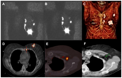 Figure 4 Patient with breast cancer with drainage to axillary and internal mammary chain.