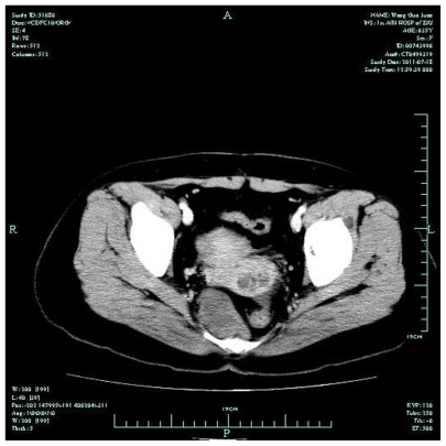 Figure 1 Computed tomographic image of neurolemmoma.