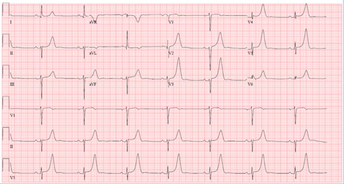 Figure 1. Patient's initial ECG (5.5 h after last seen normal)