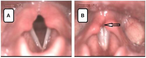 Figure 3 Asymmetry of arytenoid cartilages with edema and redness of intraarytenoid area; (A) respiratory position of vocal folds, (B) phonatory position of vocal folds.