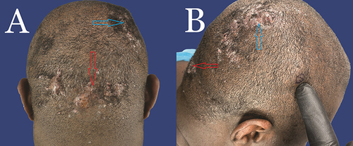 Figure 1 (A) Posterior view of a patient with histopathologically proven diagnosis of AKN in the nape area (red arrow) and FD in the right vertex area (Blue arrow). There is a vast zone of NAS outside of the AKN and FD zones. (B) Same patient showing AKN (nape – red arrow) and FD (right vertex – blue arrow) and a marked parietal NAS area targeted for biopsy. There is a vast zone of NAS outside of the AKN and FD zones.