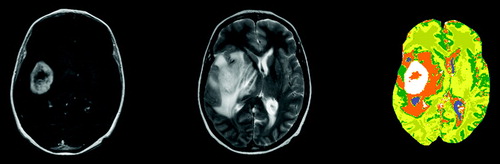 Figure 3.  T1, T2 and the segmented image of a brain with a tumor.