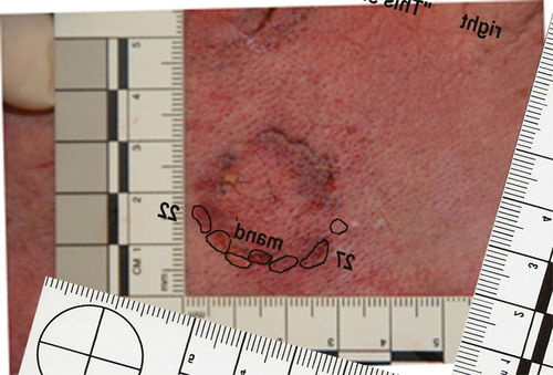 Figure 2. Bite mark with analytical overlay of mandibular incisal edges. The overlay is inverted for proper orientation. Source: Anthony R. Cardoza, DDS, D-ABFO.