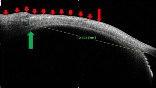 Figure 5 In a recessed medial rectus muscle, the anterior ocular coat contour appears to be normal, whereas from original insertion onwards (long red arrow) the posterior ocular coat looks variably thinned (smaller red arrows). The muscle corresponding hypoechoic area can be seen at 10.8 mm. Hence, in the presence of disturbed posterior coat contour and distally situated muscle specifications, a recessed muscle is evident (green arrow). The later elevations along outer ocular coats were due to the conjunctival fold and/or the plica semilunaris (later small arrows).