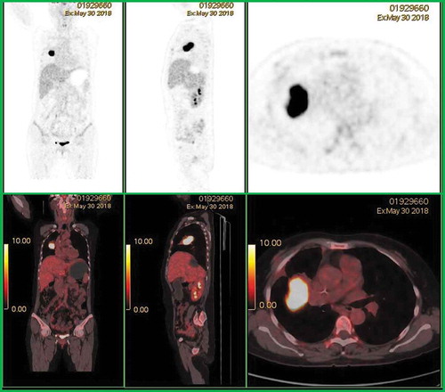 Figure 2. After administration of R2-CHOP chemotherapy regimens, positron emission tomography-computed tomography showed a soft tissue mass adjacent to the right upper pulmonary lobe with high fluorodeoxyglucose uptake, suggesting progression of tumor activity.
