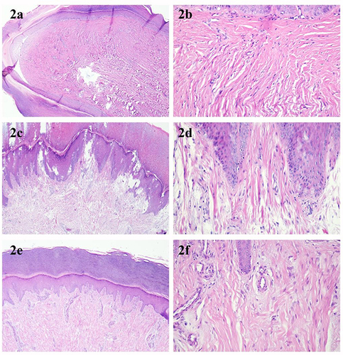 Figure 2 Histopathological manifestations of ADF (a) Case 1, with digital papules visible (40x); (b) Case 1, thickened and red-stained collagen bundles arranged perpendicular to the epidermis and increased capillaries (200x); (c) Case 2, obvious hyperkeratosis and epidermal thickening (40x); (d) Case 2, collagen fiber bundles arranged perpendicular to the epidermis seen in the dermis, with obvious thickening and red staining (200x); (e) Case 3, tumor was flat and dome-shaped (40x); (f) Case 3, fewer fibroblasts in the dermis and hyperplastic collagen arranged perpendicular to the skin surface (200x).