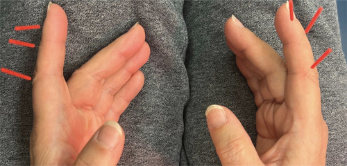 Figure 2. Acupuncture needle placement on bilateral index fingers.