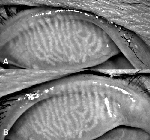 Figure 3 Meibomian gland morphology in a patient with meibomian gland dysfunction. (A) Meibomian gland morphology before treatment. (B) Meibomian gland morphology at 4 weeks after final treatment. Meibomian gland morphologies were similar in panels (A and B).