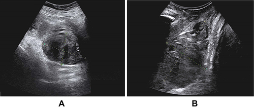 Figure 1 Grayscale ultrasound image showing a cystic solid mass with clear boundaries in the posterior vaginal wall by abdominal ultrasonography (2020.05.23, (A)) and vaginal ultrasonography (2020.05.23, (B)).