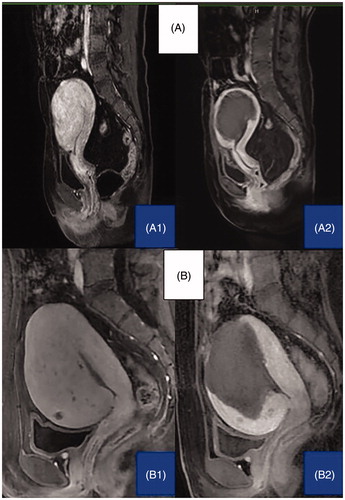 Figure 2. Representative MRI imaging of uterine adenomyoma before and 3 days after RF (A1: before RFA treatment, A2: after RFA treatment) or MW (B1: before PMWA treatment, B2: after PMWA treatment) ablation. The dark shadow shows the area of lesion ablation (non-perfused volume, NPV). The percentages of NPV were 75% and 81%, respectively.