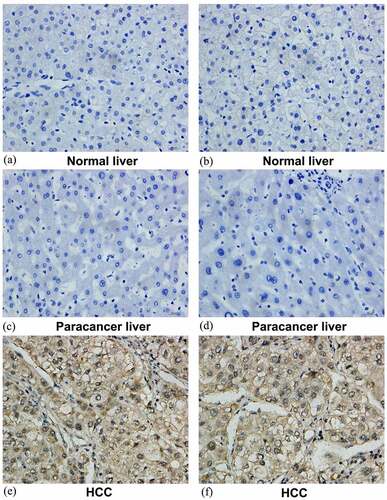 Figure 10. Representative images of SYNJ2 protein expression. Negative SYNJ2 IHC staining in normal liver (a, b) and tumor adjacent liver tissues (c, d). Positive diffused staining of SYNJ2 in HCC cells (e, f). The original images were magnified 400 times