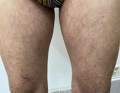 Figure 4 Darkening of erythema on both lower extremities and flattening of the papular ring elevation.