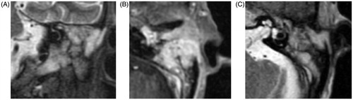 Figure 2. (A) T1-weighted coronal contrast-enhanced magnetic resonance image (B) T1-weighted axial contrast-enhanced magnetic resonance image (C) T2-weighted axial magnetic resonance image. On both T1- and T2-weighted imaging, high-intensity signals were seen in the same area as the region that exhibited soft tissue density on CT. Osteitis was also detected in the temporal bone.