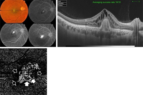 Figure 1 Upper left, color photo and FFA of the right eye of a 55-year-old male with exudative AMD and classic CNV. Upper right, corresponding SS-OCT image in radial scan mode shows hyper-reflective nodular lesion located entirely above the RPE. The lesion resulted in disruption of the retinal layers and is associated with gross intra-retinal edema which indicates type II active CNV. Lower left, “en face” SS-OCTA image of the same eye taken at the level of the outer retina in a 3×3 mm field. The neovascular complex is displayed as a hyperintense signal caused by increased blood flow within the lesion. The remaining avascular outer retina generates a hypointense signal due to absent blood flow and is displayed as a dark-gray background. The lesion demonstrates homogenous network of tiny interlacing capillaries with occasional larger vessels displayed as jet-white streaks (closed arrow heads). The entire complex is surrounded by a dark lucid interval intervening between the lesion and the surrounding normal outer retina (open arrow heads).