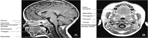 Figure S4 (A) Mid-sagittal T1-weighted image with mental spine-clivus oblique line shown (white line). Linear measurements were obtained along this line. (B) Axial T1-weighted image at the level of maximal tonsillar cross-sectional area. Note the transverse intermandibular line (white line) passing the center of each tonsil. Linear measurements were obtained along this axis. Maximal oropharyngeal width was obtained on this plane (dotted white line).Note: Reprinted with permission of the American Thoracic Society. Copyright © 2020 American Thoracic Society. Arens R, McDonough JM, Corbin AM, Hernandez ME, Maislin G, Schwab RJ, et al. 2002. Linear dimensions of the upper airway structure during development: Assessment by magnetic resonance imaging. Am J Respir Crit Care Med. 165.117–22. Official journal of the American Thoracic Society.Citation121