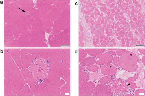 Figure 1. (a) H&E stained section of breast muscle with mild (grade 1) pathology, showing individual myofibre degeneration (arrow). (b) Higher magnification showing fragmented, pale eosinophilic sarcoplasm with infiltration by heterophils and mononuclear inflammatory cells. (c) Breast muscle with marked (grade 3) pathology characterised by widespread variation in myofibre size and shape and separation of myofibres by collagen. (d) Higher magnification showing degenerate (*) and necrotic (arrowhead) myofibres. Scale bar is 200 μm in (a) and (b) and 20 μm in (c) and (d).