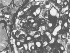 Figure 4. Membranous nephropathy showing thickened capillary walls, and numerous subepithelial “spikes” are present on the capillaries of the focused glomerulus. (Jones' silver stain, × 40).