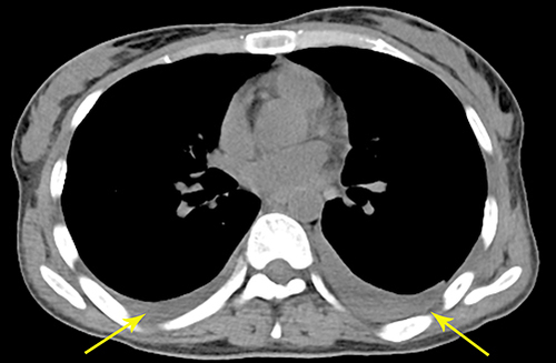 Figure 2 CT showed effusion of bilateral thoracic cavities (yellow arrow).