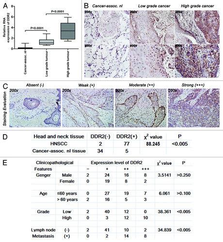 Figure 1. Expression levels of DDR2 transcripts and proteins in HNSCC clinical specimens. (A) Expression levels of DDR2 in 29 pairs of fresh primary HNSCC and corresponding normal clinical specimens were measured by qPCR. One of the low grade tumors’ transcripts (number 5) was used for normalization. (B) Immunohistochemical staining for DDR2 expression in 79 human HNSCC specimens (54 specimens of low grade tumors and 25 specimens of high grade tumors) and 39 cancer-associated normal (cancer-assoc. nl) specimens. Shown is a representative example of high grade HNSCC sample (right), low grade HNSCC sample (middle) and cancer-associated normal tissue sample (left). (C) Staining evaluation for the immunohistochemical staining of DDR2 expression. The staining grade is stratified as absent (−), weak (+), moderate (++), or strong (+++). Shown is a representative example of each grade. (D) Statistical analysis for immunohistochemical staining of DDR2 expression between human HNSCC specimens and cancer-associated normal specimens. (E) Statistical analysis for the relationship between the immunohistochemical staining of DDR2 expression and HNSCC characteristics. Data are presented as the mean ± SD or n (number of samples). Statistical significance was evaluated with the Student t test or χ2 test.