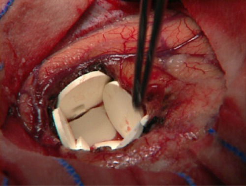 Figure 1 Carmustine wafers implanted in a glioblastoma resection cavity.