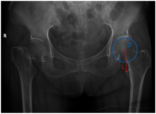 Figure 1 The diameter of the contralateral femoral head (D) and the distance between the center of the femoral head and the top of lesser trochanter (L).