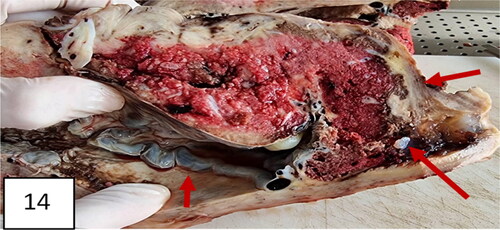 Figure 14. Another slide of uterine specimen: thinning of the cicatrix with loss of myometrium in the zone (arrows). Placenta previa, more anterior and less posterior; vasa previa.
