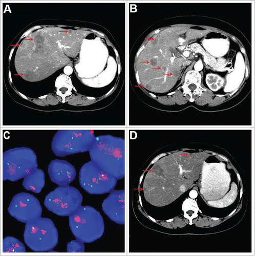 Figure 3. Imaging and molecular analysis of the patient at the first diagnosis of liver metastasis. (A and B) Abdominal CT scan showed multiple lesions in the liver (indicated by red arrow). (C) FISH assay revealed HER2 gene amplification of the second BC. (D) After treatment with trastuzumab-based triple-drug combination regimen for 3 cycles.