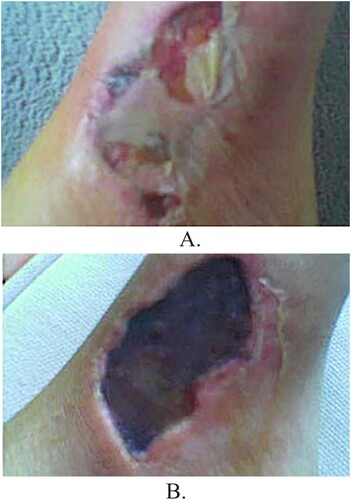 Figure 4. (A) Purulent cutaneous lesion due to L. reclusa approximately 1 week after the initial bite. (B) Dermonecrosis due to L. reclusa 2 weeks after the initial bite. (Yigit). The combination of venom components, cellular death, and aggressive inflammatory response leads to hemorrhagic necrosis and ultimately the formation of dermonecrosis with a central black eschar.