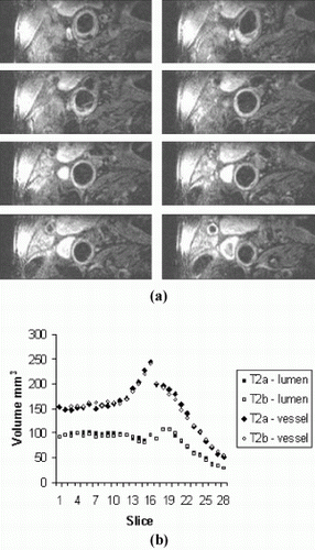 Figure 1. (a) Example of a Slices from T1-weighted TSE Scan. (b) Inter-study reproducibility of lumen and total vessel volume for patient above.