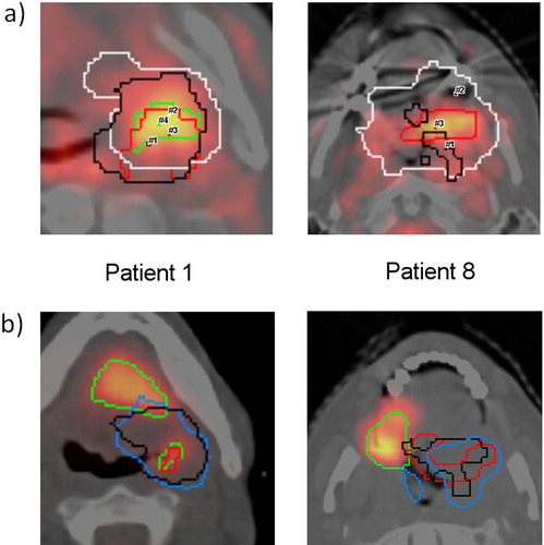 Figure 3. (A) Co-registration of FMISO subvolumes (FMISOpre = black, FMISOw1 = white, FMISOw2 = red, FMISOw5 = green) as delineated by one observer (NA) and projection of the location of maximum FMISO uptake (#) in serial FMISO-scans during therapy. Shown are the planning CTs with fusion of the FMISOw2-PET for two representative patients (# 1 and #8). Please note that the longitudinal distance between SUVmax (not shown here) substantially contributes to calculated distances. (B) Rigid co-registration of planning CT and PET-CT of local recurrence for the same patients with contours of FMISOpre (black) and FMISOw2 (red), pre-RT FDG-PET (light blue) and volume of recurrence (green). FMISO delineations of one observer (NA).
