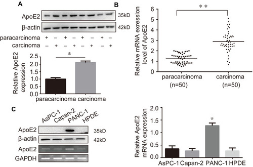 Figure 1 ApoE2 was overexpressed in pancreatic cancer tissues. (A) Western blotting analysis was performed to detect the expression levels of ApoE2 in 4 paired pancreatic cancer tissues and paracarcinoma tissues. (B) The mRNA level of ApoE2 in 50 paired pancreatic cancer tissues and paracarcinoma tissues was examined by RT-qPCR. (C) The expression levels of ApoE2 in pancreatic cancer cell lines (AsPC-1, Capan-2 and PANC-1) were measured by Western blotting and RT-qPCR (*P<0.05, **P<0.01).