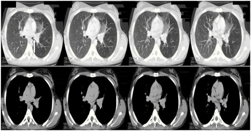 Figure 2 Chest HRCT showing nodule development in the left primary bronchus causing its partial obstruction (arrow) before treatment.