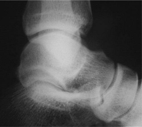 Figure 1. Case 1. Plain radiograph showing a bone spur on the dorsal aspect of the talus: the exostotic osteoid.