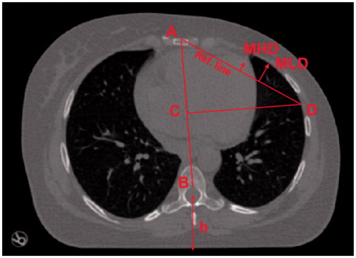 Figure 3. For each bed position, a point B at the anterior part of the medulla was set as origin for an anatomical coordinate system. A corresponding point A at the anterior part of the sternum was defined to yield the anterior–posterior axis AB. Starting from the center of AB at C, a second line was constructed perpendicular to AB reaching the lateral edge of the left lung at D. The line AD was used as reference for scoring MHD (maximum heart distance) and MLD (maximum lung distance). The reference line is roughly parallel to the treatment beam edges motivating its use as reference for distance measurements. The spine-to-couch distance h was measured to quantify the number of cases when the patient lifted the back more than 3 mm, i.e., made ‘fake-breaths’.