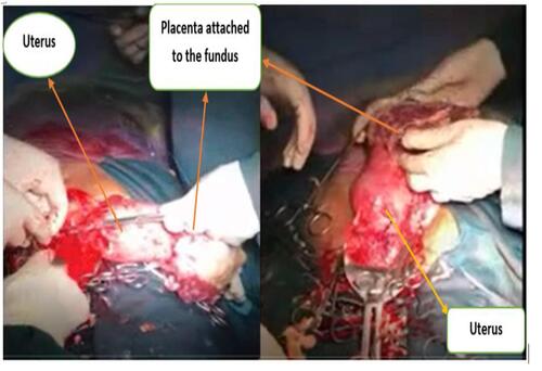 Figure 4 Picture showing placental attachment to fundus of the uterus.