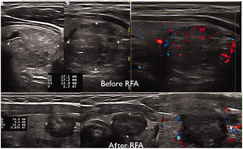 Figure 3. Ultrasound nodule features before and after procedure (radiofrequency procedure).