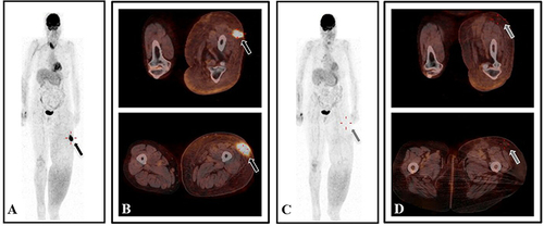 Figure 3 Complete metabolic response after fourth-line therapy with pembrolizumab. A baseline FDG-PET scan showed a left thigh subcutaneous lesion (A and B; black arrows), completely disappeared at week 24 (C and D; grey arrows).