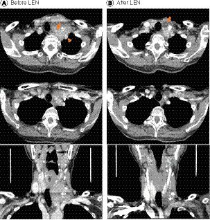 Figure 1. Dramatical tumor shrinkage by lenvatinib.(A) Computed tomography examination revealed a large irregular thyroid tumor that completely encased left internal jugular vein, involving left subclavian vein. Left common carotid artery (CCA) was involved at almost 270° by tumor (arrow). Left subclavian artery was contacted with tumor at approximately 180° (arrowhead) (left column, before LEN). (B) Tumor dramatically decreased in size after 7-week LEN administration. Arrow indicates tumor necrosis that contacted with left CCA (right column, after LEN).LEN: Lenvatinib.
