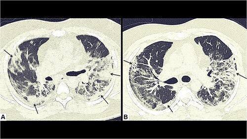 Figure 2 A 45-year-old male, a reformed smoker, and occasional alcohol consumer with sequel of COVID-19 pneumonia. The baseline CT chest at the time of admission, axial image (A) showing peripheral areas of consolidation (black arrows) with surrounding ground glass opacities (GGOs) in bilateral upper lobes. He had persistent cough even at the time of discharge, and follow-up CT chest (6 weeks after discharge), axial image (B) showing resolution in peripheral consolidation, but persistent area of interstitial thickening (black arrows) in bilateral lungs.