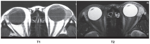 Figure 1 Magnetic resonance imaging scans of both orbits showing a well defined 15 × 10 × 10 mm tumor in the region of the left lacrimal gland and a 3 × 5 × 3 mm tumor in the right lacrimal gland. Signals higher than that of the external muscles in T1 image (right), and about the same intensity as brain cortex in the T2 image (left).
