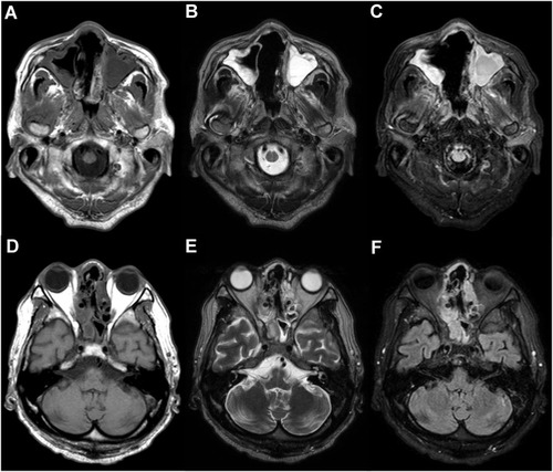 Figure 3 Magnetic resonance imaging (MRI) on admission. Horizontal views of (A and D) T1-weighted, (B and E) T2-weighted, and (C and F) FLAIR images at the level of (A–C) the maxillary sinus and (D–F) the eyeballs. The nasal septum was disrupted (A–C) and structural deformation with mucosal thickening and fluid retention were observed in the maxillary, ethmoid and sphenoid sinuses (A–F).