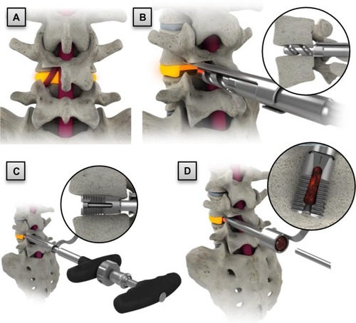 Figure 3 Transforaminal lumbar interbody fusion procedure highlights: (A) implant site preparation; (B) sizing; (C) implant insertion and expansion; and (D) bone graft placement. Insets illustrate magnified and cross-sectional views.