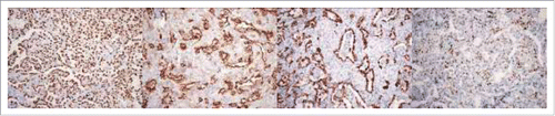 Figure 3. Two populations of cells in PSP were present: solid growing polygonal round cells with pale cytoplasm and papillary structures covered with cuboidal surface cells. Cuboidal surface cells expressed TTF-1 (A), EMA (B) and AE1/3 (C), and round or polygonal cells expressed TTF-1 (A), EMA (weakly) (B), PR (partially) (D).