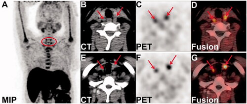 Figure 1. The imaging of parathyroid glands in 18F-fluorocholine PET/CT imaging.