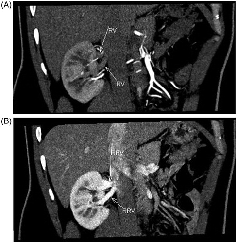 Figure 1. MDCT angiogram in 32-year-old male renal donor with two right renal veins. Oblique coronal maximum intensity projection (MIP) of early arterial (A) and venous phase (B) images illustrate two right renal veins (arrows).