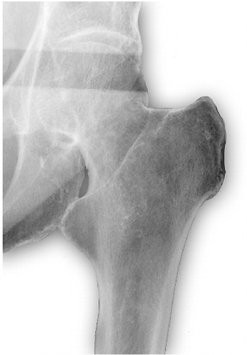 b. Undisplaced femoral neck fracture.