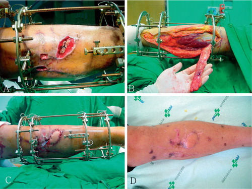 Figure 4. A: A 37-year‐old man sustained a skin defect and bone exposure in the anterior aspect of the left lower leg. Proximally based superficial sural artery flap was performed to cover this defect. B. The proximally based sural artery flap was 5 cm x 7 cm in size, and 18 cm in pedicle length. C. A photograph taken immediately after surgery. D. At the 1-year follow‐up examination, the flap had healed well.
