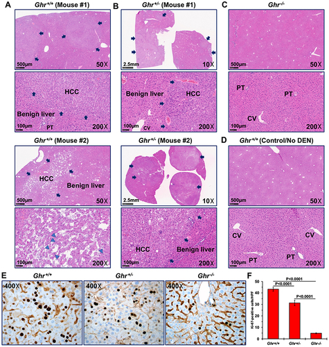 Figure 3 DEN-induced HCC in Ghr+/+ and Ghr+/- mice resembles to a great extent human HCC. Representative examples of hematoxylin and eosin-stained liver sections from (A, upper and lower panels) Ghr+/+, (B, upper and lower panels) Ghr+/-, and (C) Ghr−/− mice that were injected with DEN. (D) Liver sections from a control Ghr+/+ mouse that was not injected with DEN is also shown as an example. Arrows highlight HCC tumor nodules in the Ghr+/+ and Ghr+/- liver tissues. There are foci of markedly increased mitotic figures (arrowheads). HCC is not present in the livers from the Ghr−/− mouse treated with DEN and the Ghr+/+ control mouse that was not treated with DEN. PT and CV denote portal tract and central vein, respectively. (E) IHC staining with Ki-67 shows increased PI in HCC that developed in Ghr+/+ and Ghr+/- mice after DEN injection, compared with low PI in liver tissues from Ghr−/− mice that were also injected with DEN, yet did not develop HCC. (F) The means ± SE of the numbers of Ki-67+ cells per HPF. The H&E photomicrographs were captured using the NanoZoomer S50 Digital slide scanner (Hamamatsu, Bridgewater, NJ), and the Ki-67 photomicrographs using an Olympus BX41 microscope (Olympus Scientific Solutions Americas Corp., Waltham, MA), Infinity 3 camera (Teledyne Lumenera, Ottawa, Ontario, Canada), and Infinity Capture software (version 6.3.2., Teledyne Lumenera). Original magnifications are shown.